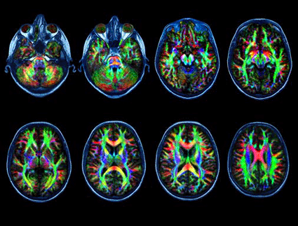 Image: Through Diffusion Tensor Imaging (DTI), a type of neuroimaging that builds on MRI technology, doctors can monitor the health of the brain's white matter (Photo courtesy of scienceNOW). Image: Through Diffusion Tensor Imaging (DTI), a type of neuroimaging that builds on MRI technology, doctors can monitor the health of the brain's white matter (Photo courtesy of scienceNOW).